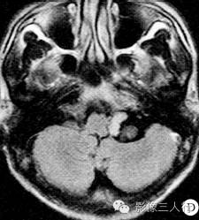 【病例】左侧桥小脑角区脉络丛乳头状瘤1例CT及MR影像表现 【病例】左侧桥小脑角区脉络丛乳头状瘤1例CT及MR影像表现