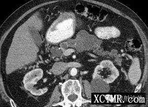【病例】胰腺导管内乳头状黏液肿瘤1例CT影像表现
