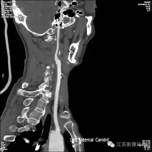颈内动脉应用解剖 颈内动脉应用解剖