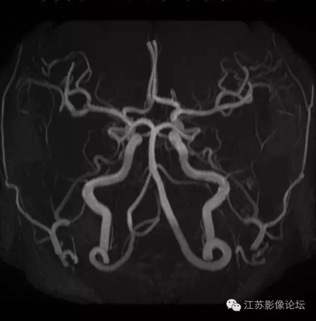 颈内动脉应用解剖 颈内动脉应用解剖