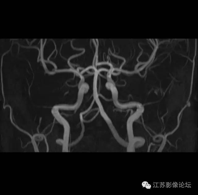 颈内动脉应用解剖 颈内动脉应用解剖