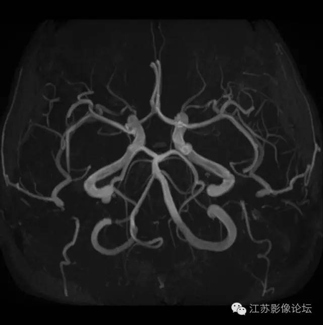 颈内动脉应用解剖 颈内动脉应用解剖