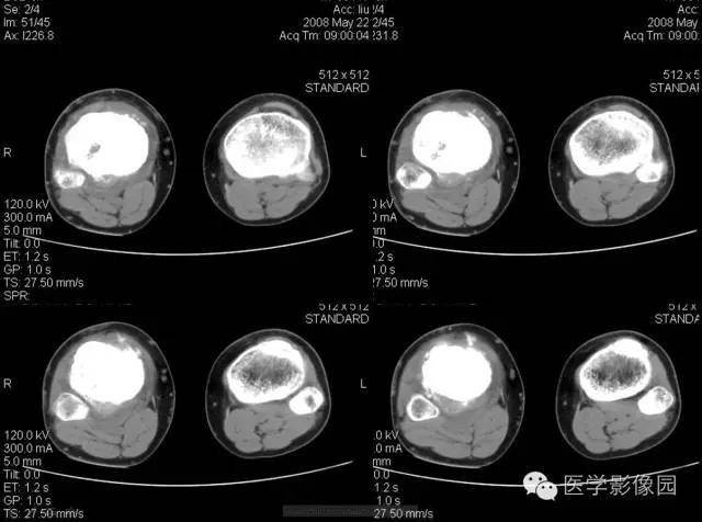 【病例】胫骨硬化性骨肉瘤1例CT影像表现 【病例】胫骨硬化性骨肉瘤1例CT影像表现