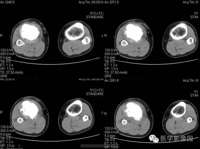 【病例】胫骨硬化性骨肉瘤1例CT影像表现 【病例】胫骨硬化性骨肉瘤1例CT影像表现