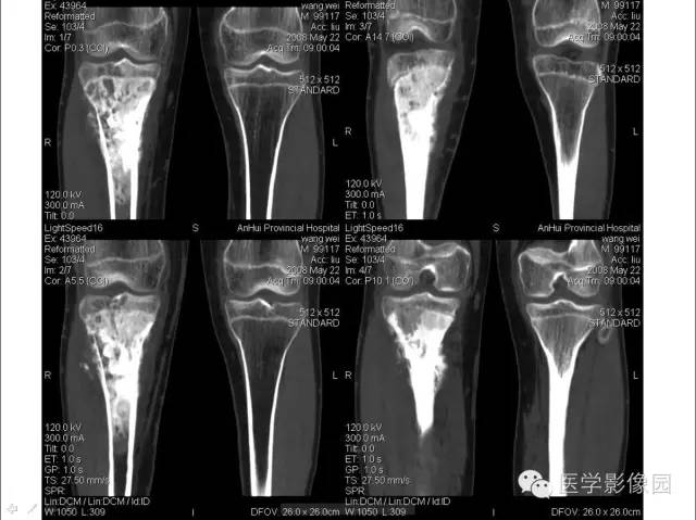 【病例】胫骨硬化性骨肉瘤1例CT影像表现 【病例】胫骨硬化性骨肉瘤1例CT影像表现