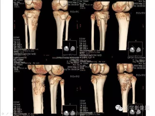 【病例】胫骨硬化性骨肉瘤1例CT影像表现 【病例】胫骨硬化性骨肉瘤1例CT影像表现