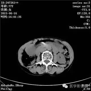 【病例】胃间质瘤1例CT影像表现