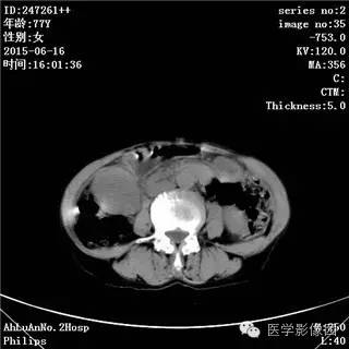 【病例】胃间质瘤1例CT影像表现
