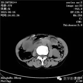 【病例】胃间质瘤1例CT影像表现