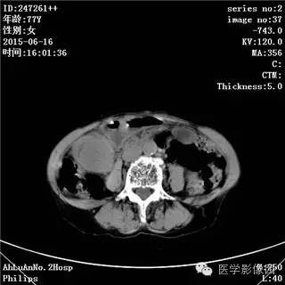 【病例】胃间质瘤1例CT影像表现