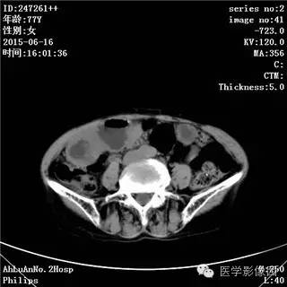 【病例】胃间质瘤1例CT影像表现