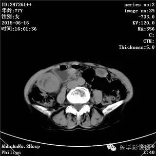 【病例】胃间质瘤1例CT影像表现