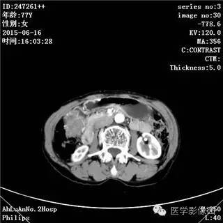 【病例】胃间质瘤1例CT影像表现