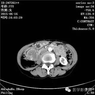 【病例】胃间质瘤1例CT影像表现