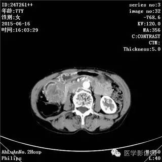 【病例】胃间质瘤1例CT影像表现