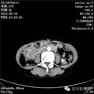 【病例】胃间质瘤1例CT影像表现