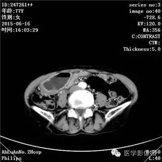 【病例】胃间质瘤1例CT影像表现