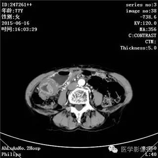 【病例】胃间质瘤1例CT影像表现
