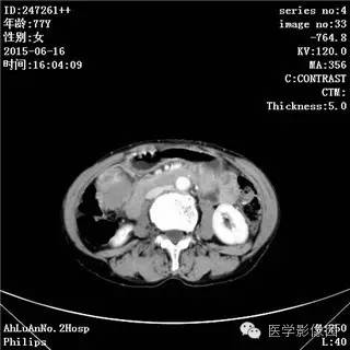 【病例】胃间质瘤1例CT影像表现