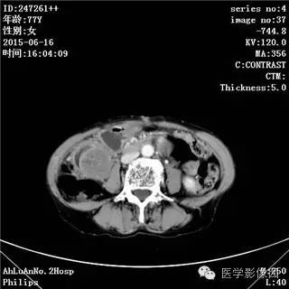 【病例】胃间质瘤1例CT影像表现