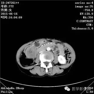 【病例】胃间质瘤1例CT影像表现