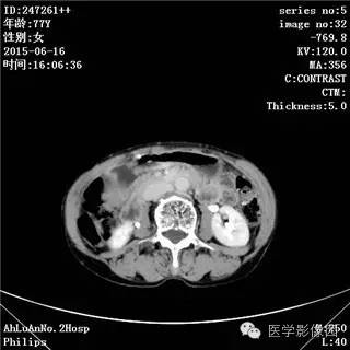 【病例】胃间质瘤1例CT影像表现
