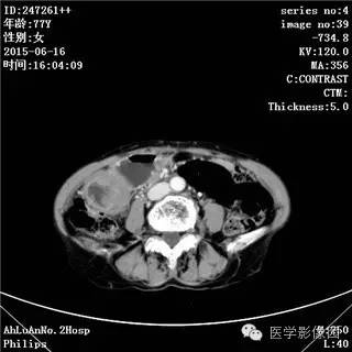 【病例】胃间质瘤1例CT影像表现
