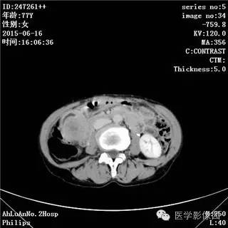 【病例】胃间质瘤1例CT影像表现