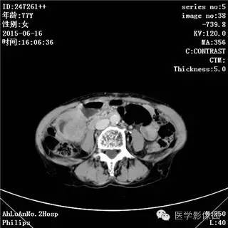【病例】胃间质瘤1例CT影像表现