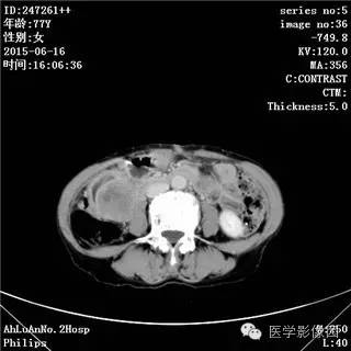 【病例】胃间质瘤1例CT影像表现