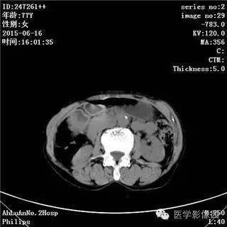 【病例】胃间质瘤1例CT影像表现