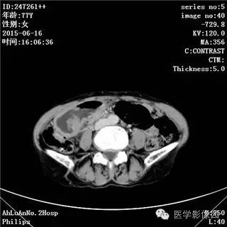 【病例】胃间质瘤1例CT影像表现