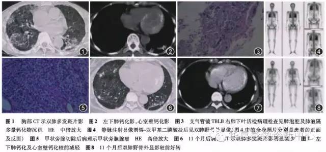 【病例】原发性甲状旁腺功能亢进1例