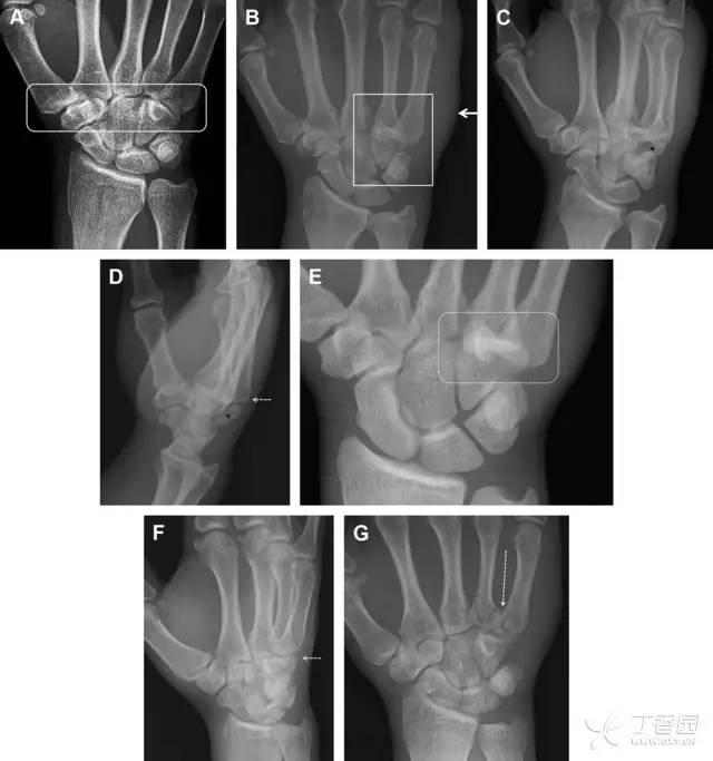 这 7 种手腕部骨折千万别漏诊