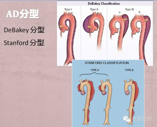 【PPT】急性主动脉综合征(AAS)
