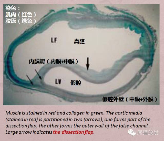 【PPT】急性主动脉综合征(AAS)