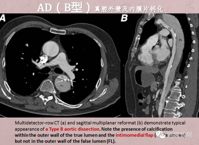【PPT】急性主动脉综合征(AAS)