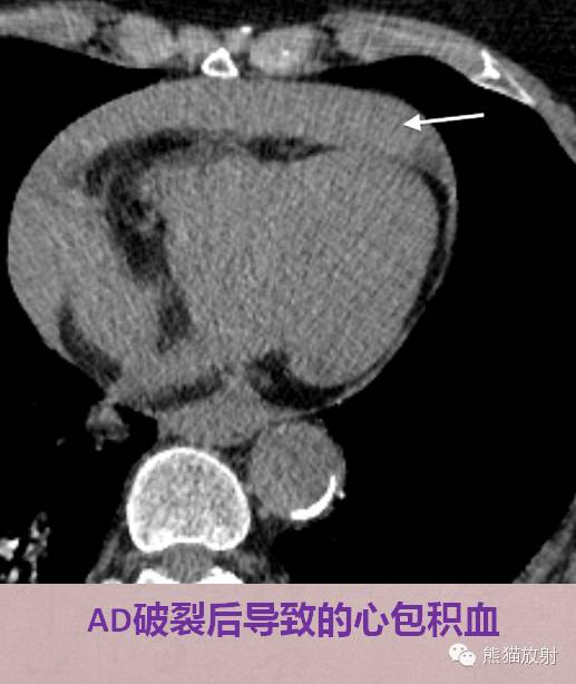 【PPT】急性主动脉综合征(AAS)