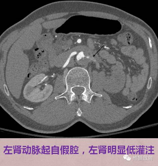 【PPT】急性主动脉综合征(AAS)