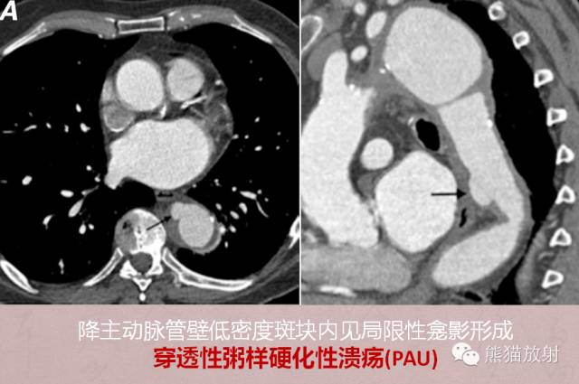 【PPT】急性主动脉综合征(AAS)
