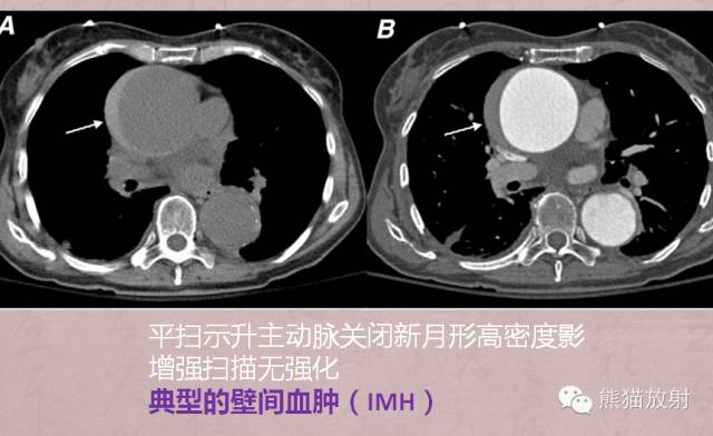 【PPT】急性主动脉综合征(AAS)