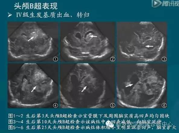 【PPT】新生儿缺氧缺血性脑病影像学表现