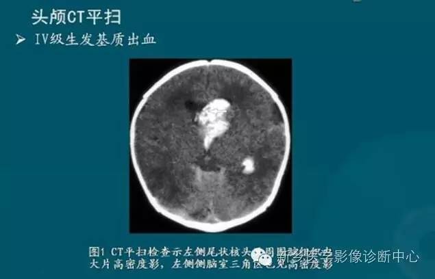 【PPT】新生儿缺氧缺血性脑病影像学表现