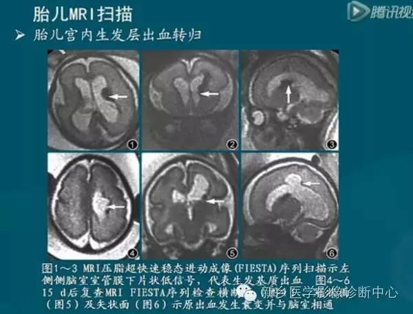 【PPT】新生儿缺氧缺血性脑病影像学表现