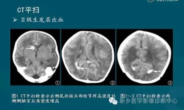 【PPT】新生儿缺氧缺血性脑病影像学表现