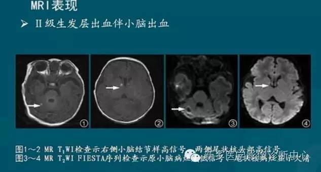 【PPT】新生儿缺氧缺血性脑病影像学表现