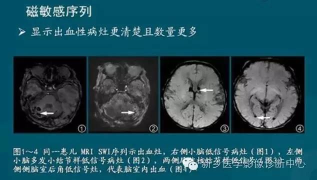 【PPT】新生儿缺氧缺血性脑病影像学表现