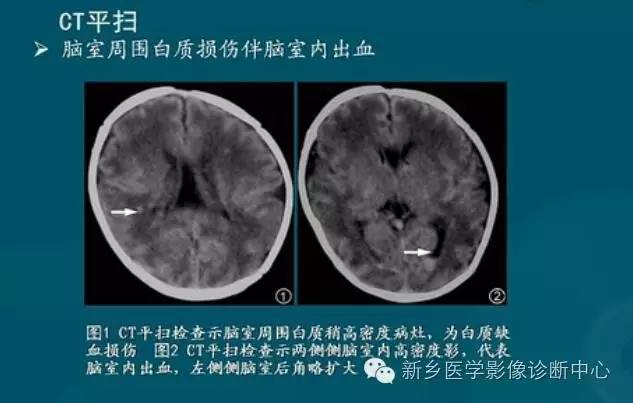 【PPT】新生儿缺氧缺血性脑病影像学表现