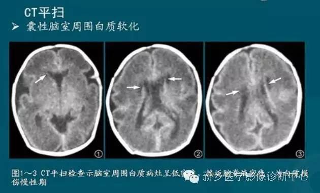 【PPT】新生儿缺氧缺血性脑病影像学表现