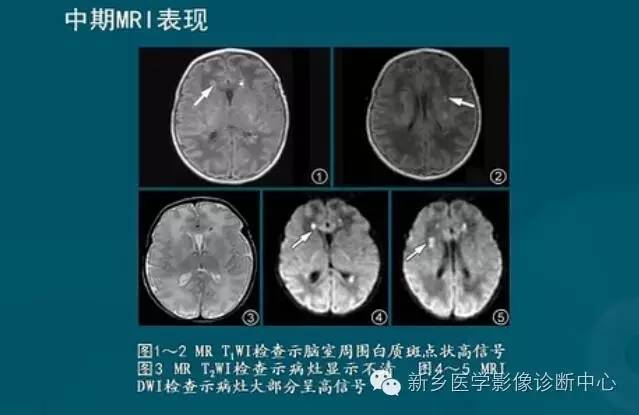 【PPT】新生儿缺氧缺血性脑病影像学表现